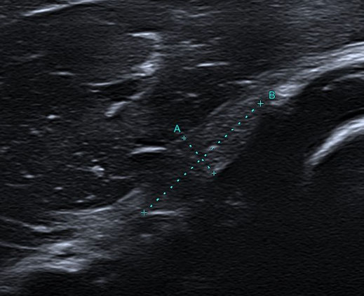 Intraneurales Perineuriom - N. Radialis