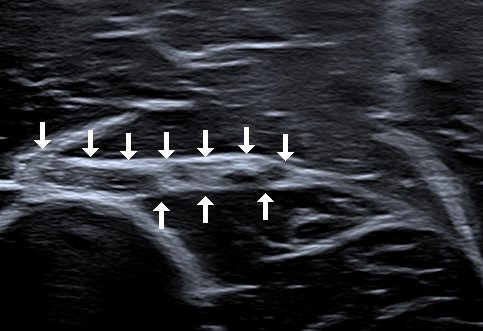 Intraneurales Perineuriom Radialis Oberarm - Borchert Neurologie