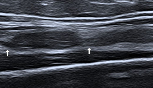 Nerventorsion N. radialis am Oberarm